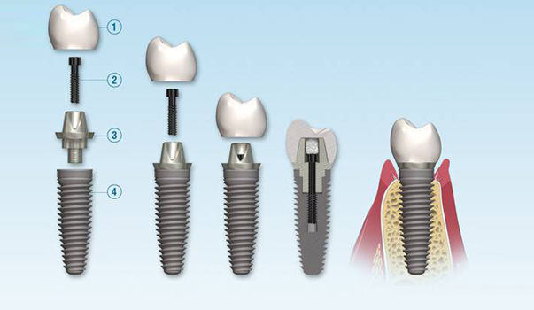 Dental Implants