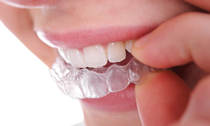 invisalign-removable-braces