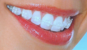 clarity-clear-brackets-mouth closeup